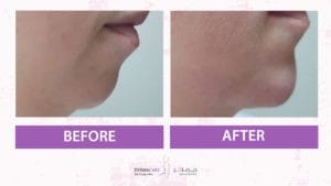 Chin and Jawline Treatement