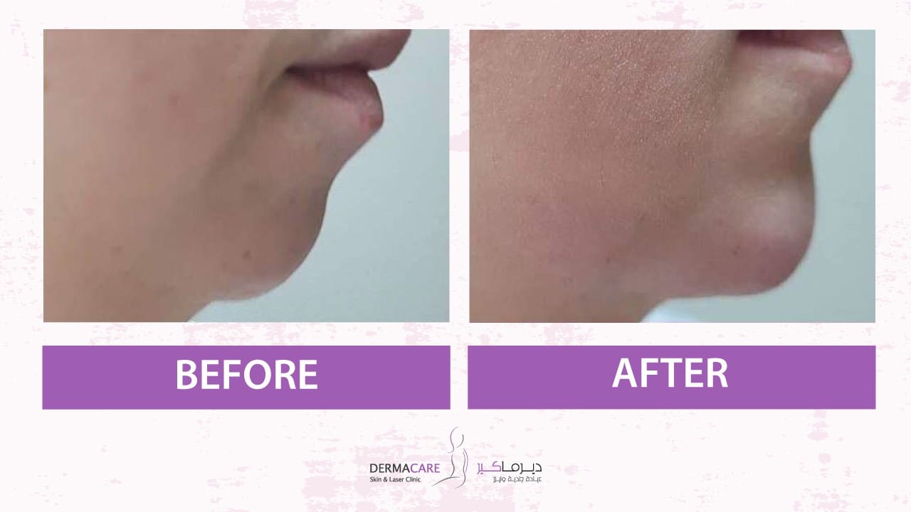 Chin and Jawline Treatement