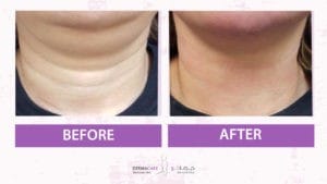 Double Chin and Neck