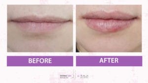 Filler Treatment