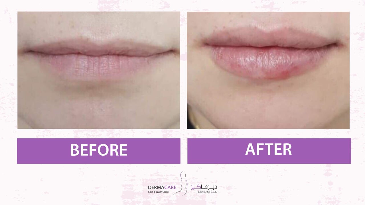 Filler Treatment