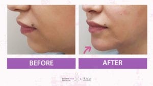 Chin and Jawline Treatement