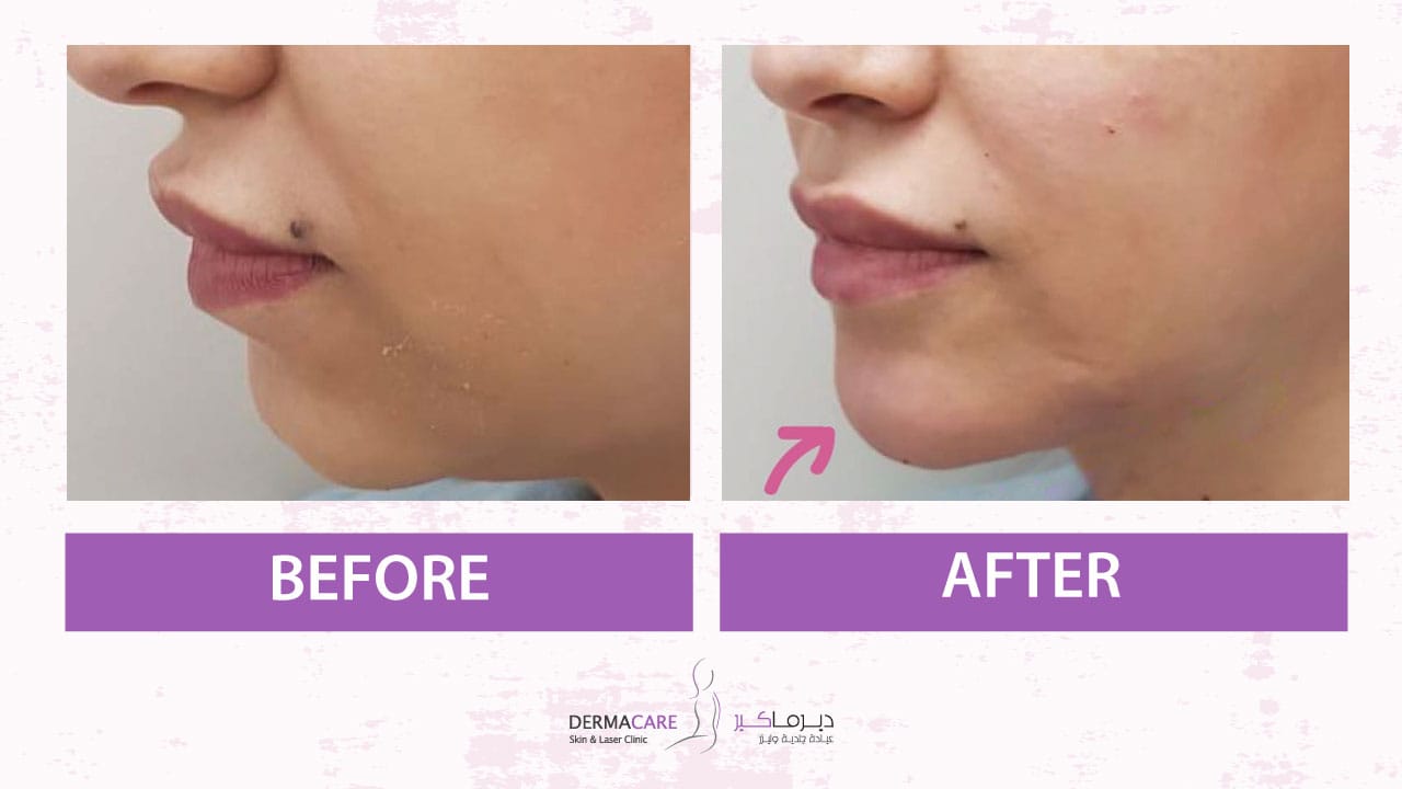 Chin and Jawline Treatement