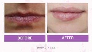 Filler Treatment