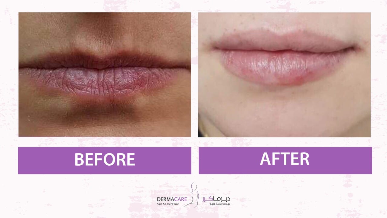 Filler Treatment