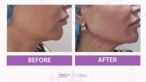 Chin and Jawline Treatement