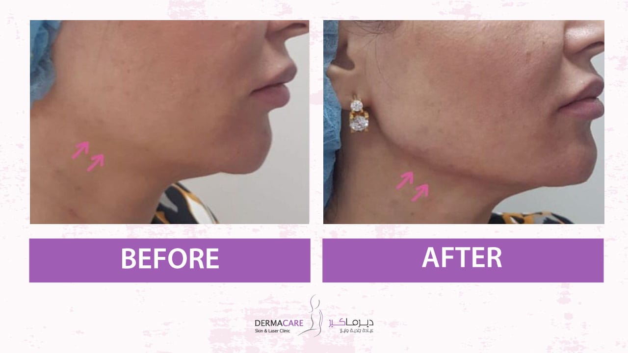 Chin and Jawline Treatement