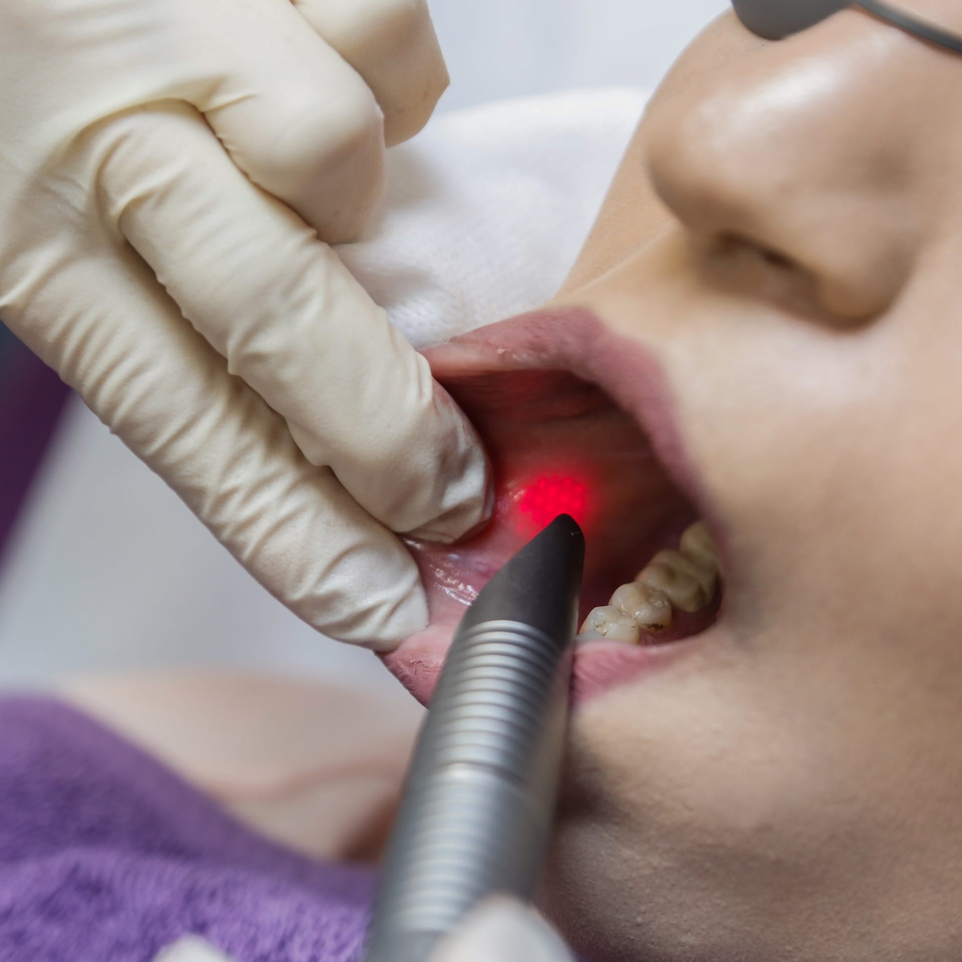 Intra-oral laser - face sculpting - Image 2