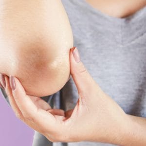 علاج التصبغات الداكنة