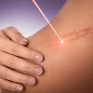 علاج الندبات وآثار الحروق