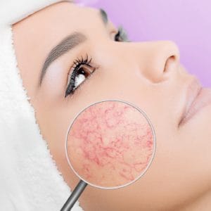 علاج احمرار الوجه