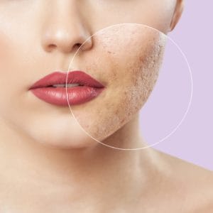 علاج ندبات حب الشباب