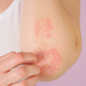 علاج الصدفية (Psoriasis) في عمان الأردن بإشراف د.فريدة طنوس