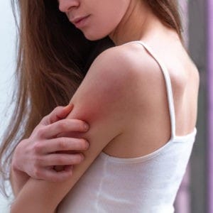 Eczema