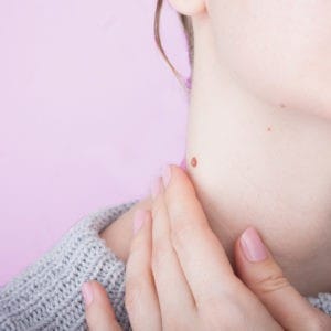 Skin tags