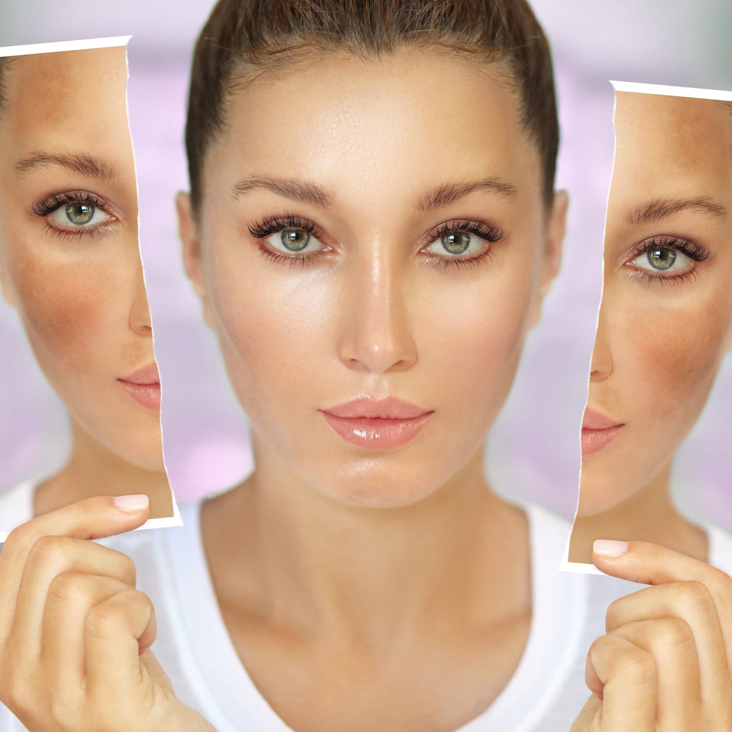 Melasma and hyperpigmentation: - Image 2