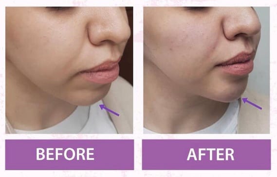 Chin augmentation - Image 3