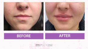 Filler Treatment