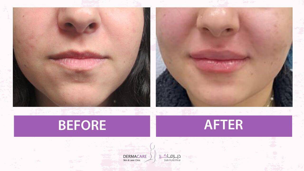 Filler Treatment
