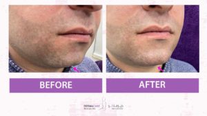 Chin and Jawline Treatement