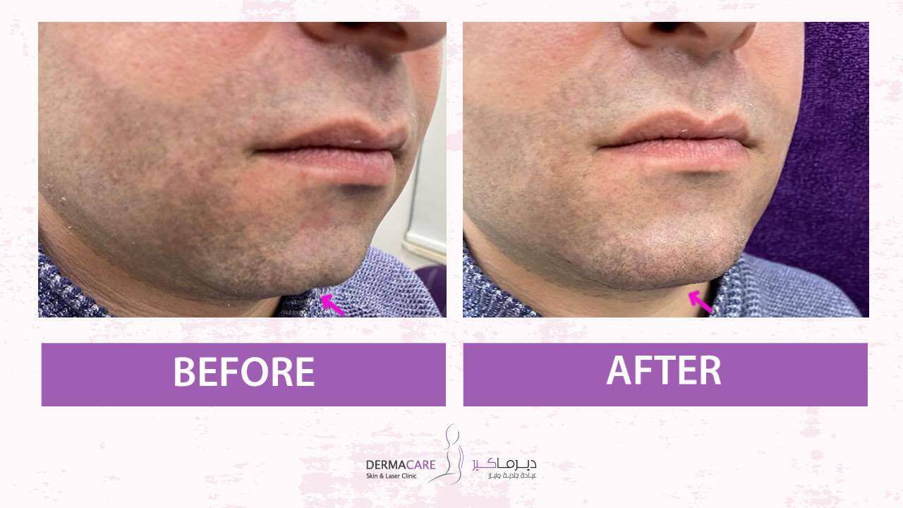 Chin and Jawline Treatement