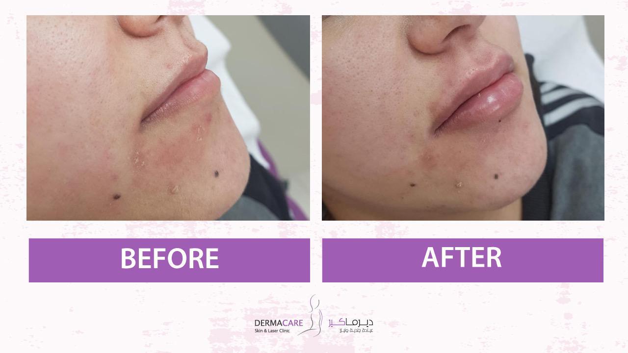 Filler Treatment