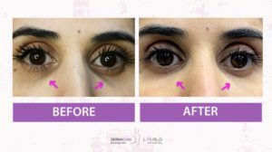 Filler Treatment