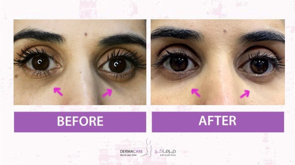 Filler Treatment