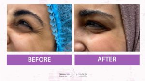 Botox Treatement