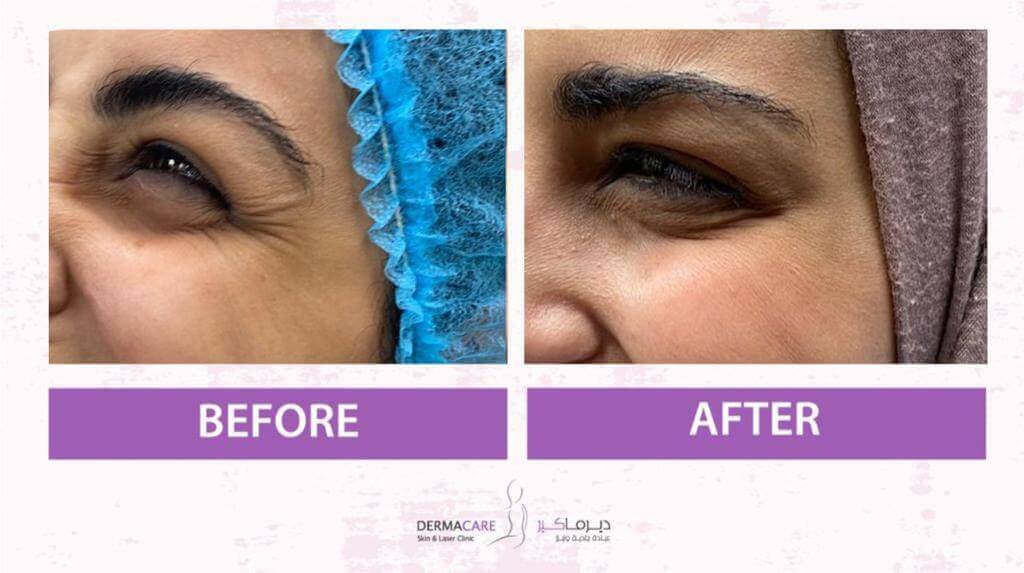 Botox Treatement