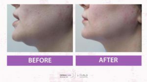 Chin and Jawline Treatement