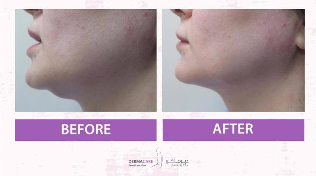 Chin and Jawline Treatement