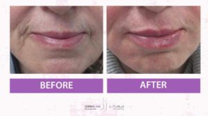 Filler Treatment