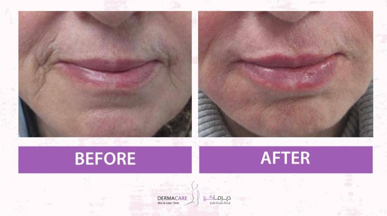 Filler Treatment