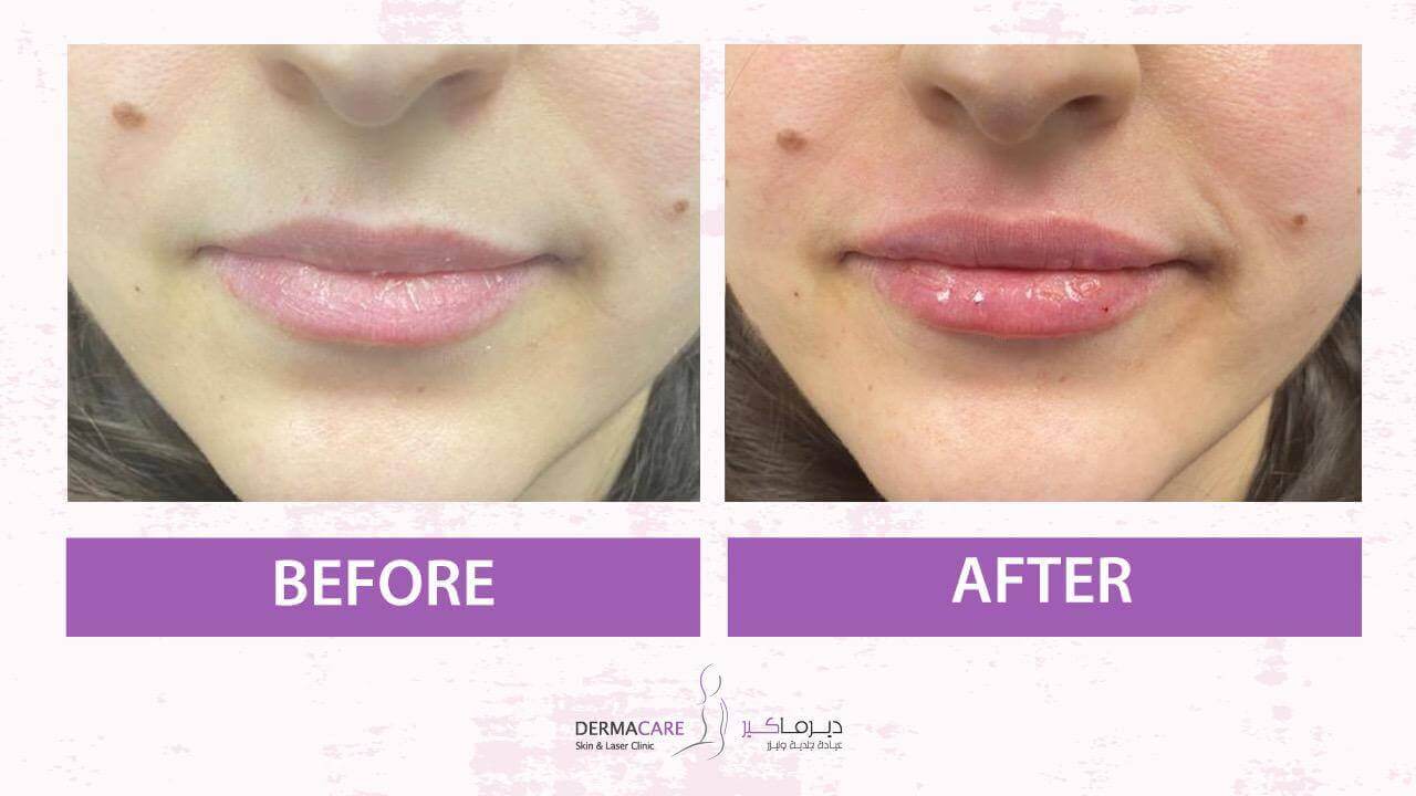 Filler Treatment
