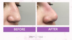 Filler Treatment