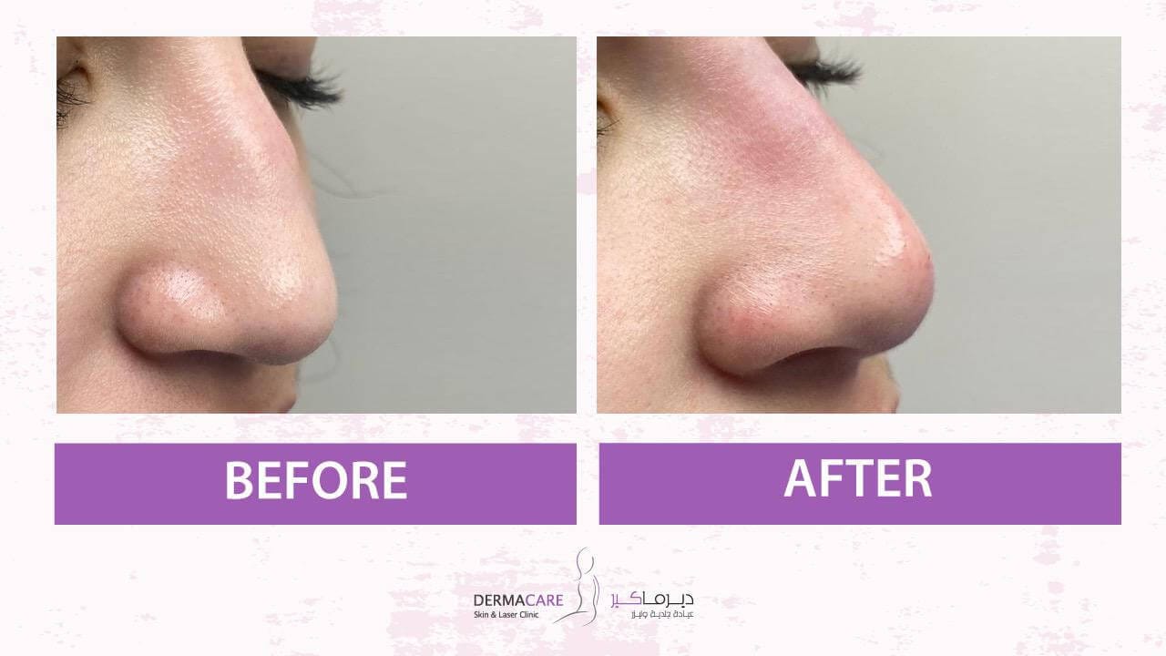 Filler Treatment