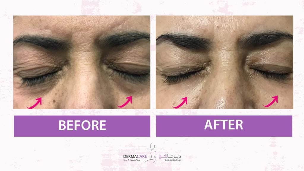 Non-surgical Face Lift
