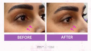 Filler Treatment