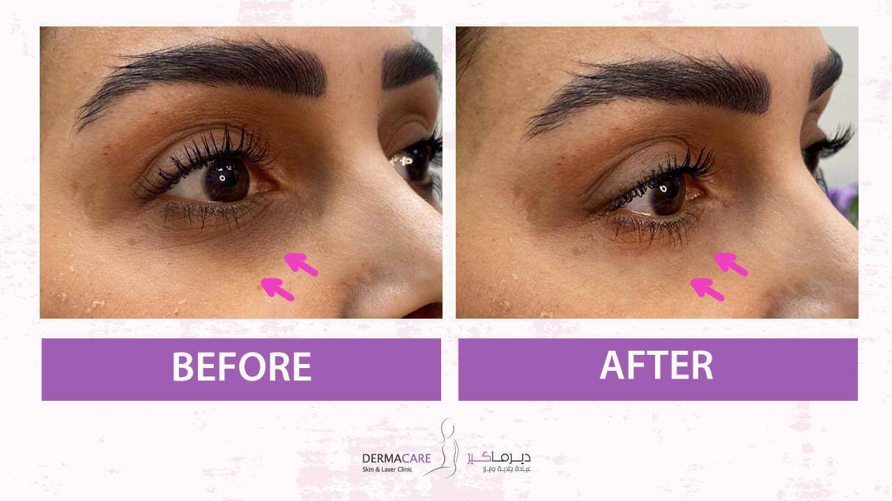 Filler Treatment
