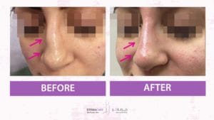 Filler Treatment