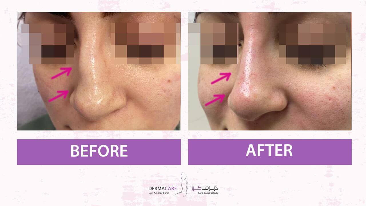 Filler Treatment