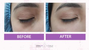 Filler Treatment
