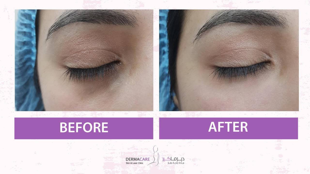 Filler Treatment