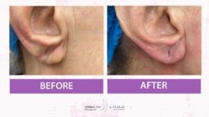 Filler Treatment