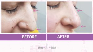 Filler Treatment