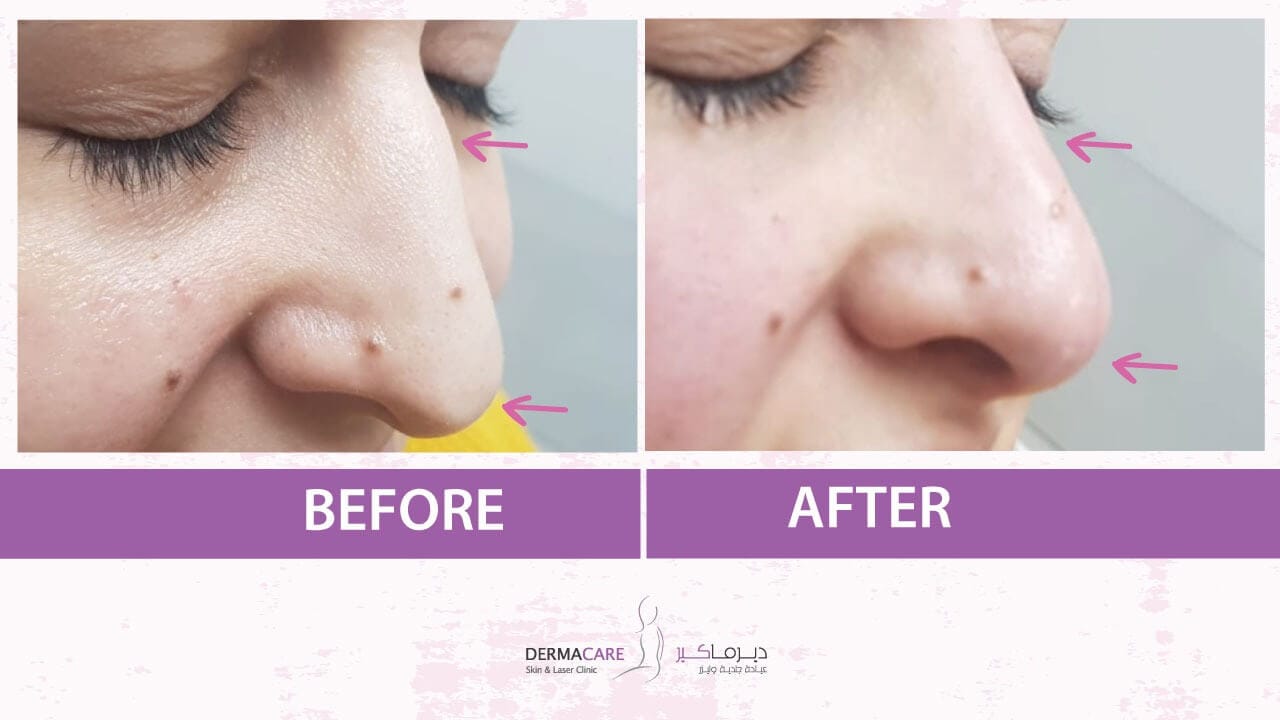 Filler Treatment