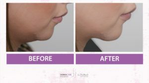 Chin and Jawline Treatement