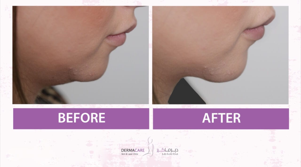 Chin and Jawline Treatement