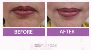 Filler Treatment